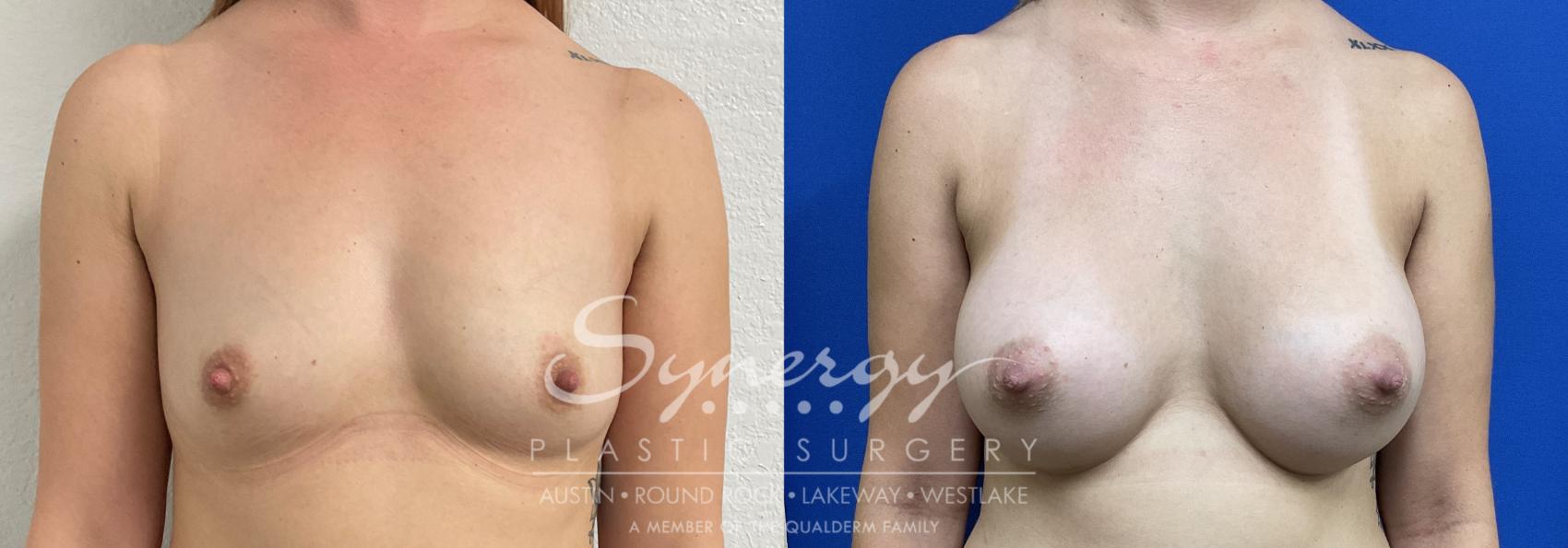 Breast Augmentation, Synergy Plastic Surgery, Silicone 