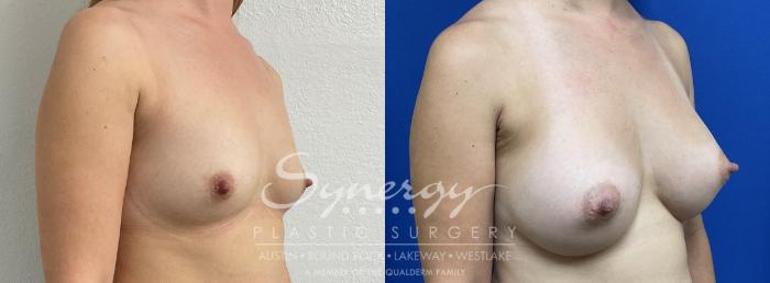 Breast Augmentation, Synergy Plastic Surgery, Silicone 