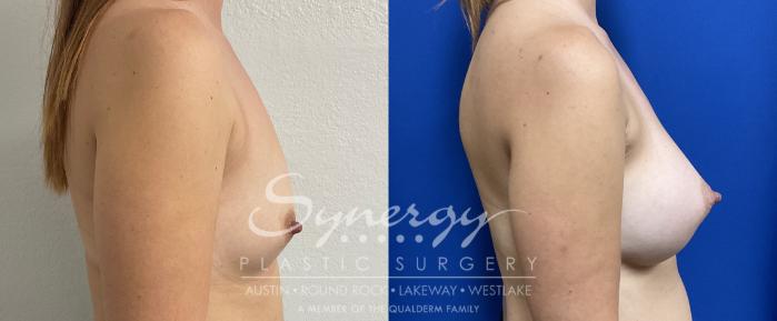 Breast Augmentation, Synergy Plastic Surgery, Silicone 