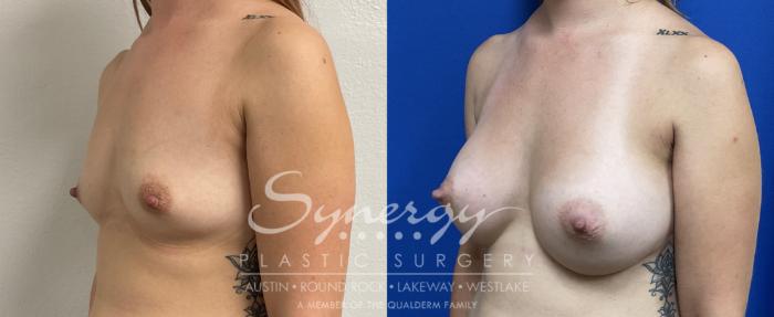 Breast Augmentation, Synergy Plastic Surgery, Silicone 