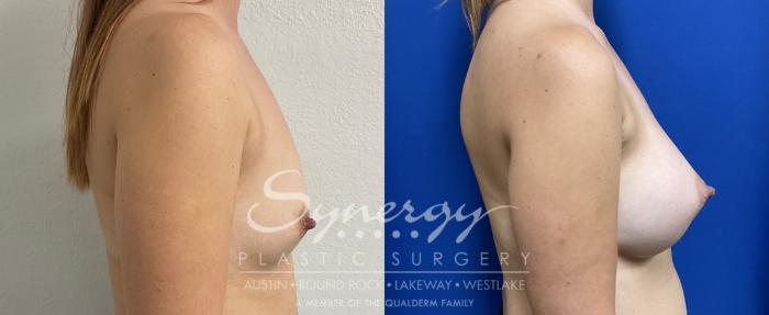 Breast Augmentation, Synergy Plastic Surgery, Silicone 