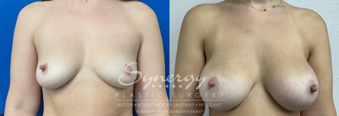 Breast Augmentation, Synergy Plastic Surgery, Silicone 