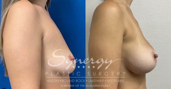 Breast Augmentation, Synergy Plastic Surgery, Silicone 