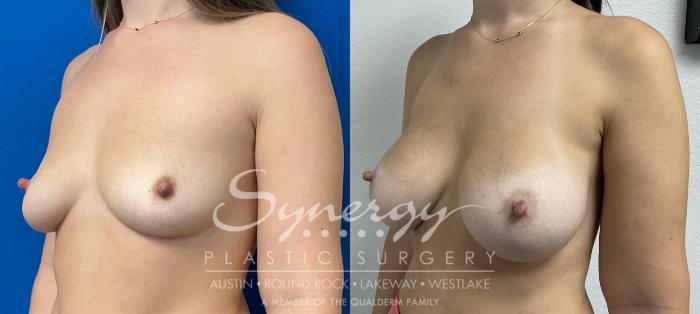 Breast Augmentation, Synergy Plastic Surgery, Silicone 
