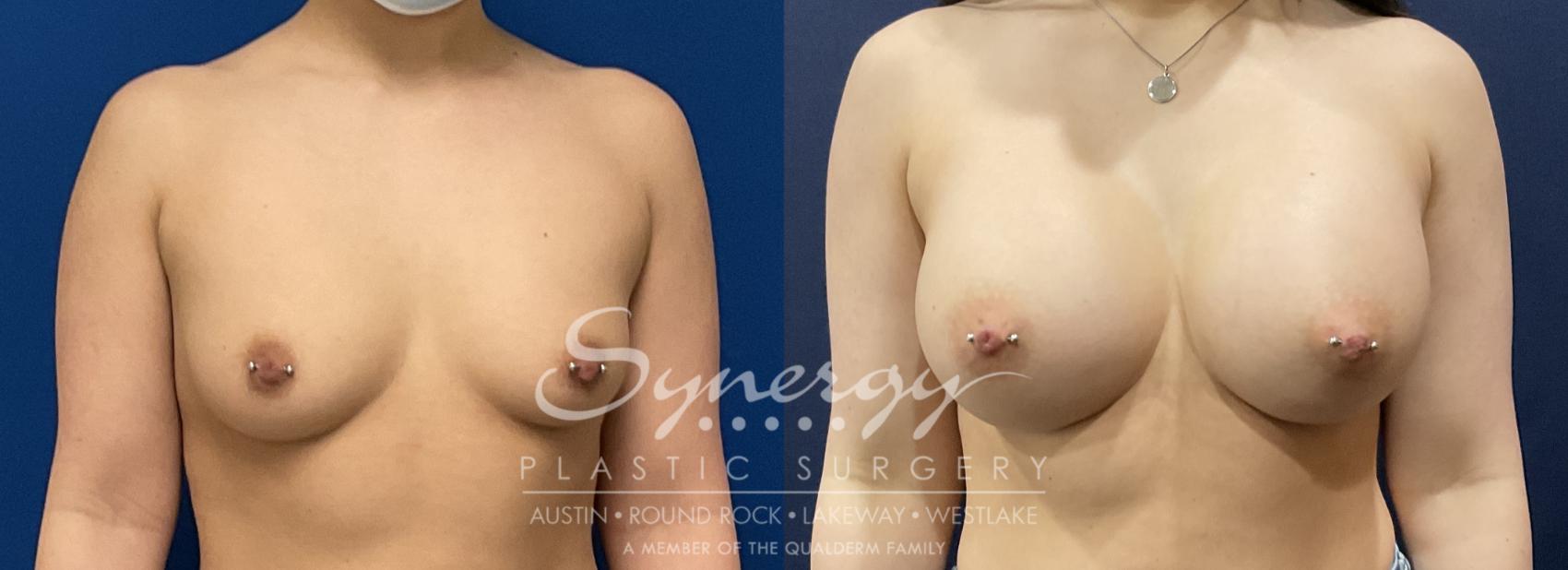 Breast Augmentation, Synergy Plastic Surgery, Silicone 