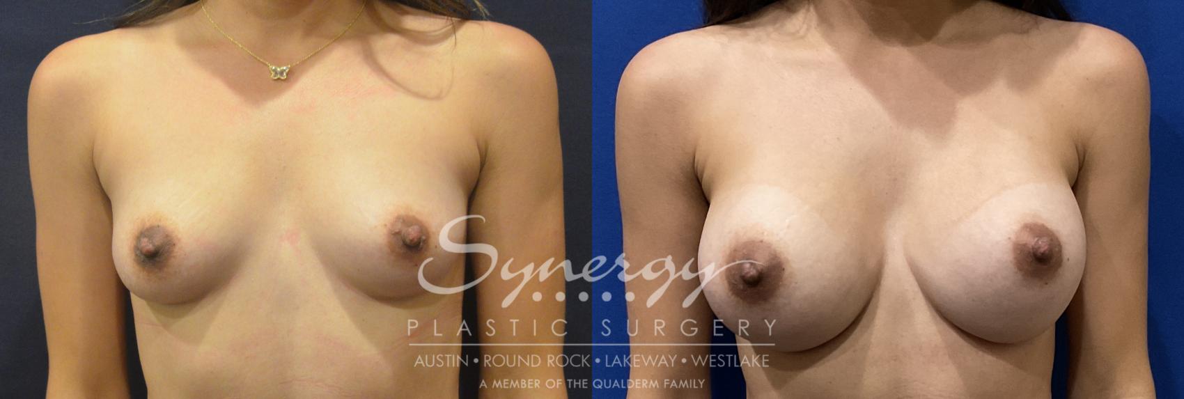 Breast Augmentation, Synergy Plastic Surgery, Silicone 