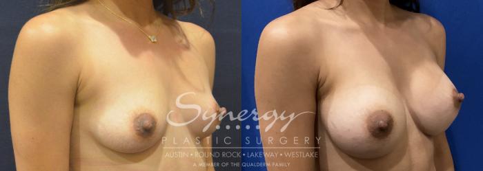 Breast Augmentation, Synergy Plastic Surgery, Silicone 