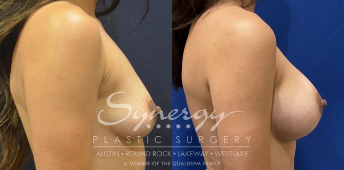 Breast Augmentation, Synergy Plastic Surgery, Silicone 