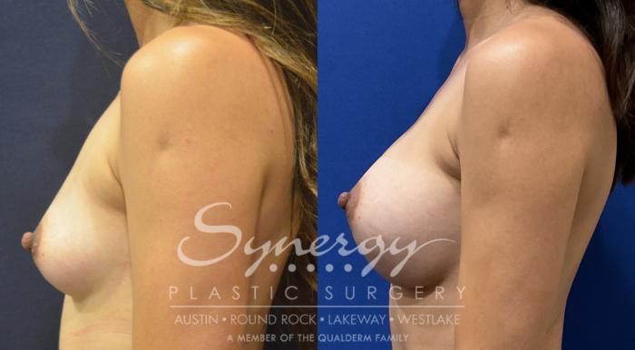 Breast Augmentation, Synergy Plastic Surgery, Silicone 