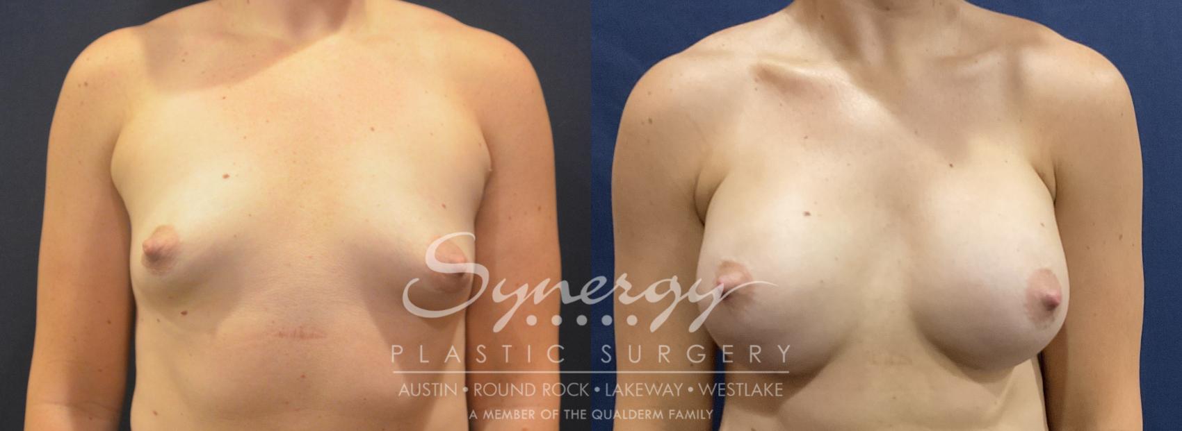 Breast Augmentation, Synergy Plastic Surgery, Silicone 