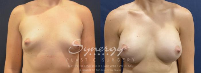 Breast Augmentation, Synergy Plastic Surgery, Silicone 