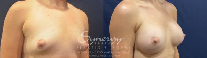 Breast Augmentation, Synergy Plastic Surgery, Silicone 