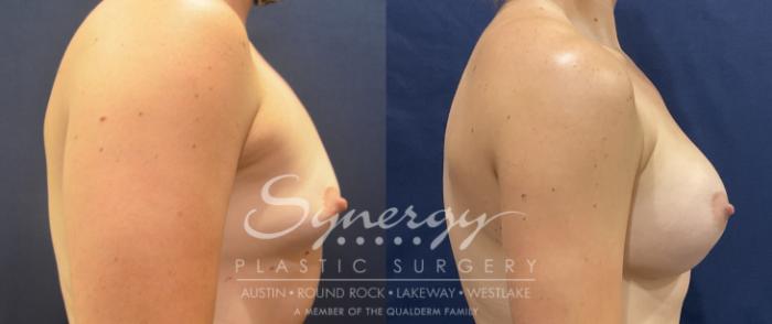 Breast Augmentation, Synergy Plastic Surgery, Silicone 
