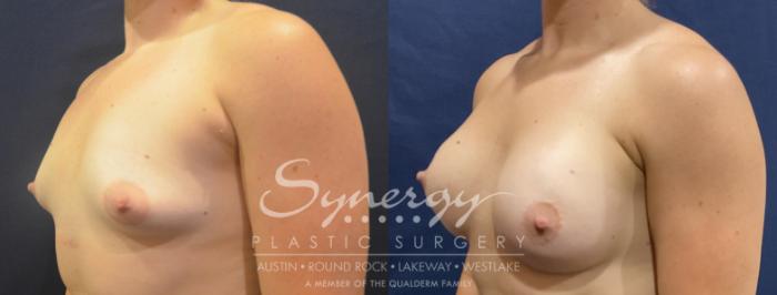 Breast Augmentation, Synergy Plastic Surgery, Silicone 
