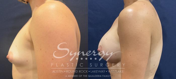 Breast Augmentation, Synergy Plastic Surgery, Silicone 