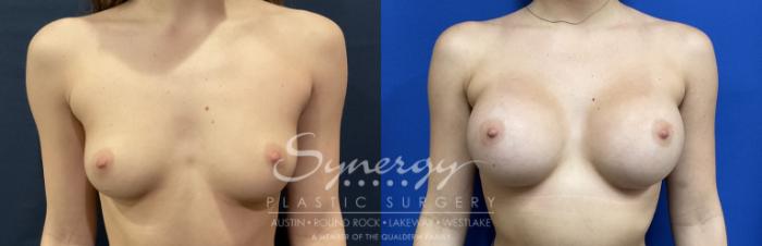 Before & After Breast Augmentation Case 818 Front View in Austin, TX