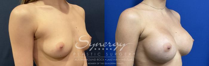 Before & After Breast Augmentation Case 818 Left Oblique View in Austin, TX