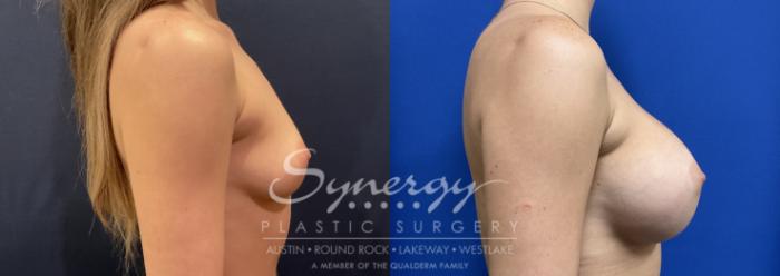 Before & After Breast Augmentation Case 818 Left Side View in Austin, TX