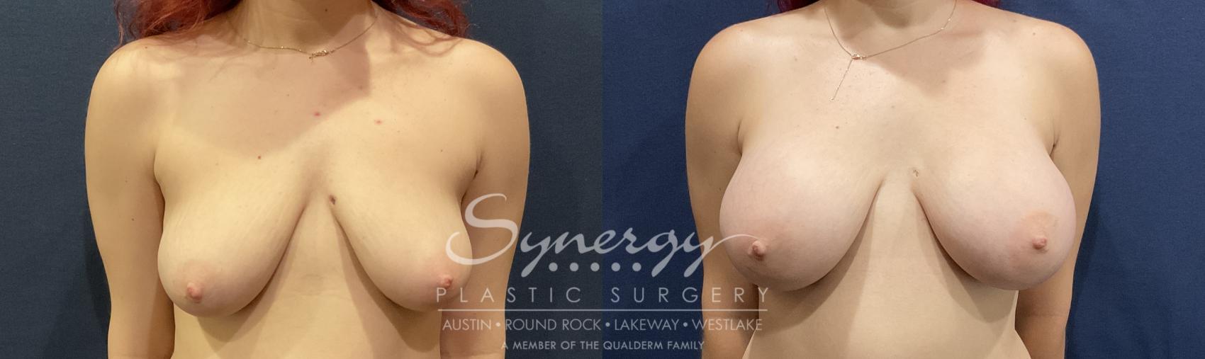 Before & After Breast Augmentation Case 819 Front View in Austin, TX