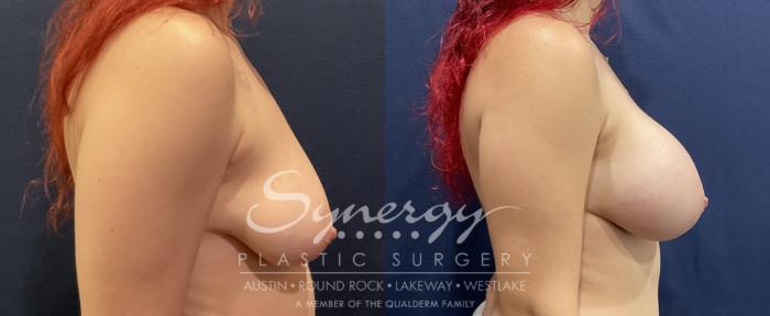 Before & After Breast Augmentation Case 819 Left Side View in Austin, TX