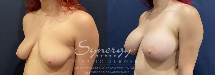 Before & After Breast Augmentation Case 819 Right Oblique View in Austin, TX