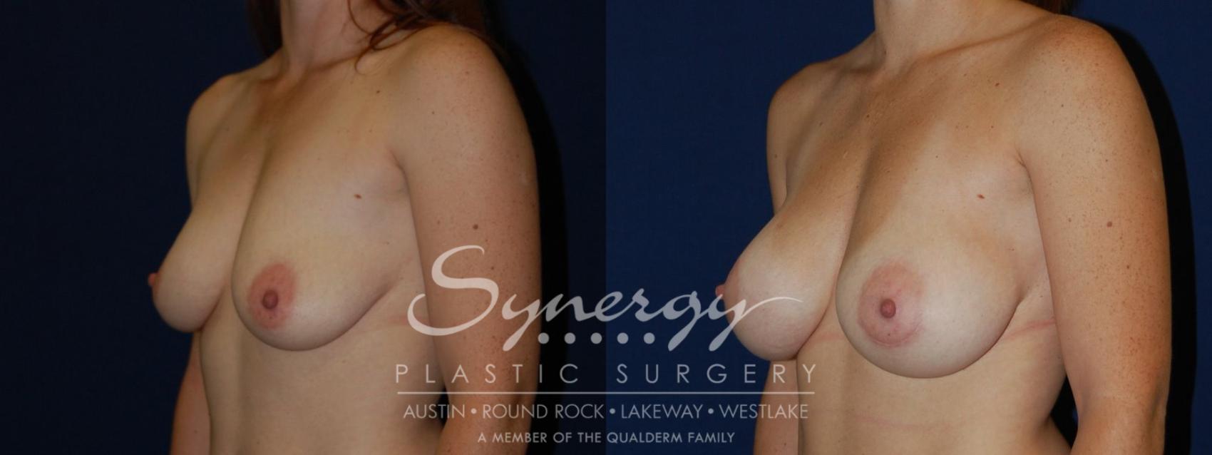 Before & After Breast Augmentation Case 82 View #2 View in Austin, TX