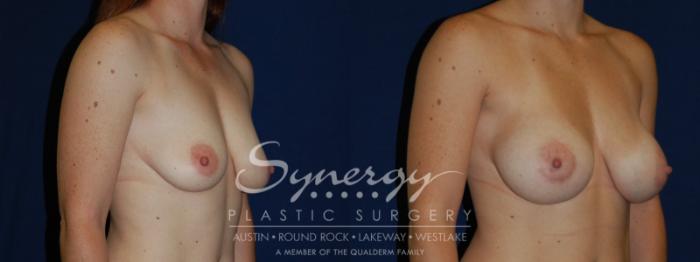 Before & After Breast Augmentation Case 82 View #3 View in Austin, TX