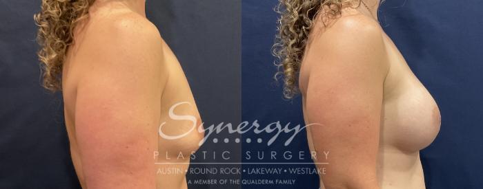 Before & After Breast Augmentation Case 821 Left Side View in Austin, TX