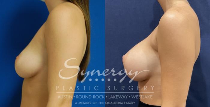 Before & After  Case 822 Right Side View in Austin, TX