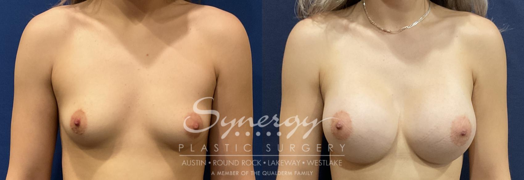 Before & After Breast Augmentation Case 823 Front View in Austin, TX