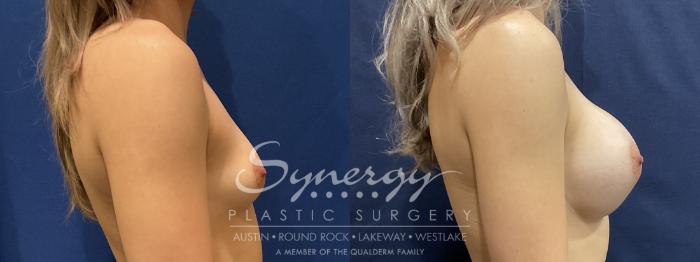 Before & After Breast Augmentation Case 823 Left Side View in Austin, TX