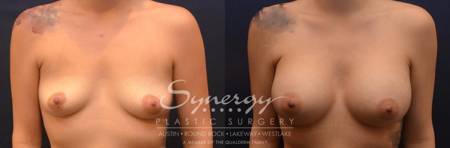 Before & After Breast Augmentation Case 833 Front View in Austin, TX