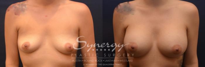 Before & After Breast Augmentation Case 833 Front View in Austin, TX