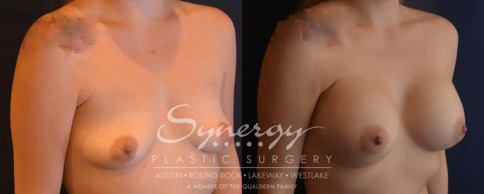 Before & After Breast Augmentation Case 833 Left Oblique View in Austin, TX