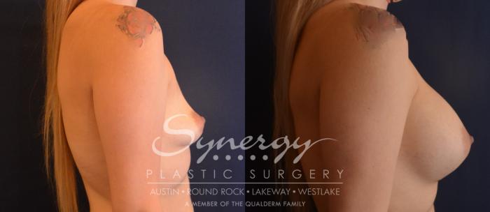 Before & After Breast Augmentation Case 833 Left Side View in Austin, TX