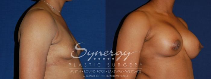 Before & After Breast Augmentation Case 85 View #4 View in Austin, TX