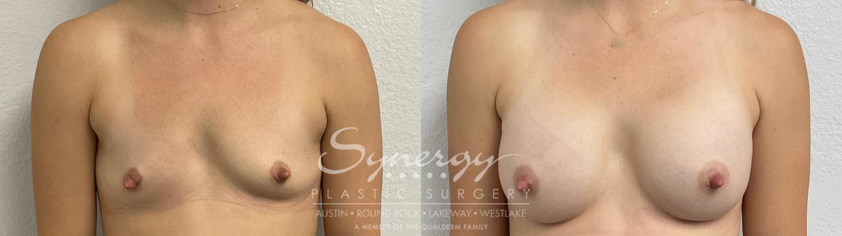 Before & After Breast Augmentation Case 858 Front View in Austin, TX