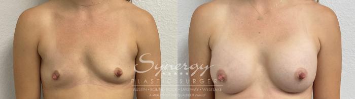 Before & After Breast Augmentation Case 858 Front View in Austin, TX