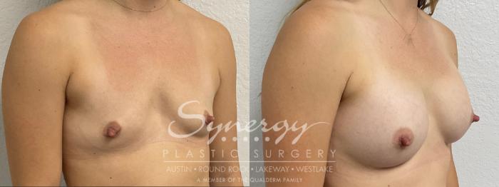 Before & After Breast Augmentation Case 858 Left Oblique View in Austin, TX