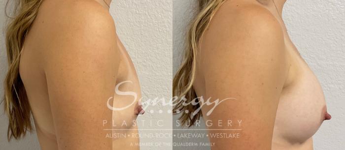 Before & After Breast Augmentation Case 858 Left Side View in Austin, TX