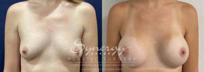 Before & After Breast Augmentation Case 863 Front View in Austin, TX