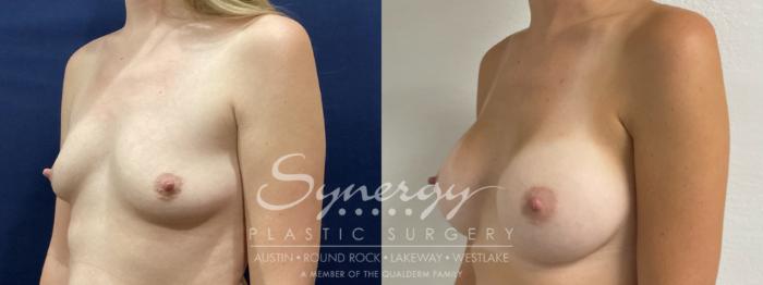 Before & After Breast Augmentation Case 863 Left Oblique View in Austin, TX