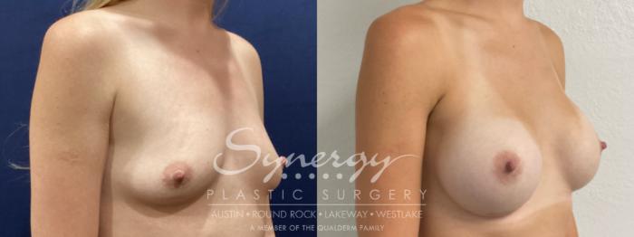 Before & After Breast Augmentation Case 863 Right Oblique View in Austin, TX