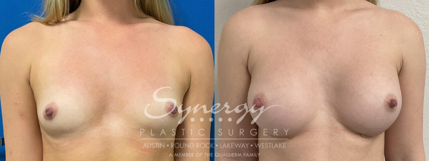 Before & After  Case 864 Front View in Austin, TX