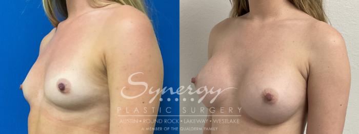Before & After  Case 864 Left Oblique View in Austin, TX