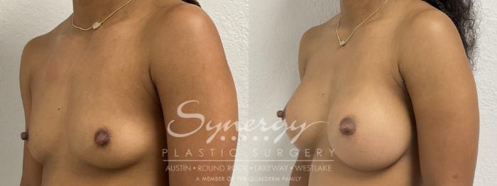 Before & After Breast Augmentation Case 865 Left Oblique View in Austin, TX