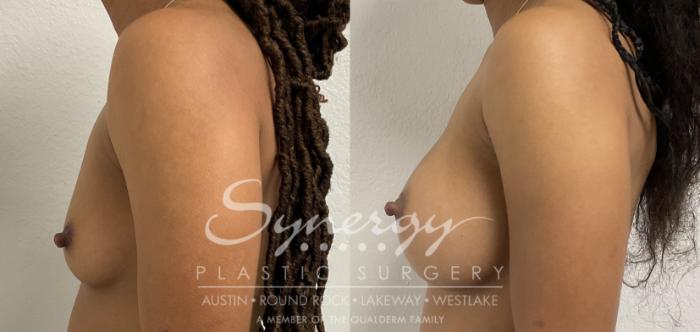 Before & After Breast Augmentation Case 865 Left Side View in Austin, TX