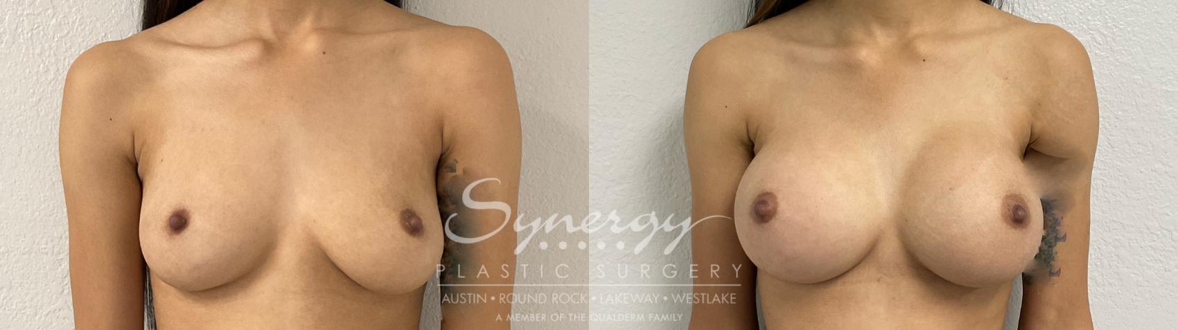 Before & After Breast Augmentation Case 870 Front View in Austin, TX