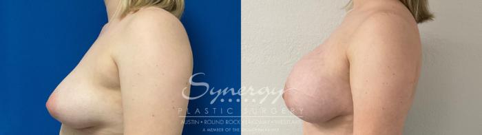 Before & After Breast Augmentation Case 872 Right Side View in Austin, TX