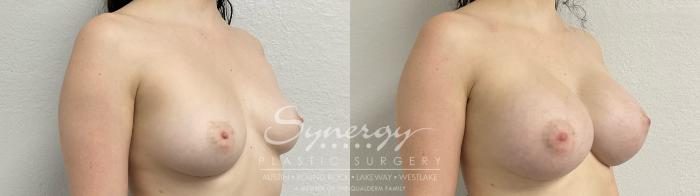 Before & After Breast Augmentation Case 873 Left Oblique View in Austin, TX